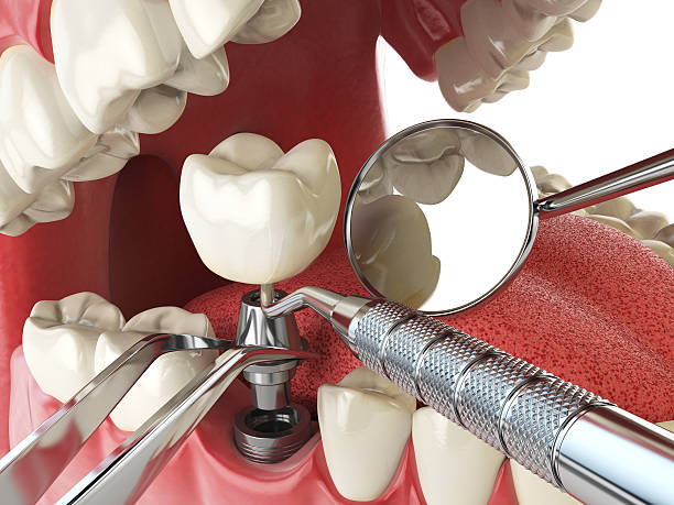 Best Emergency Root Canal Treatment in Northlake, TX